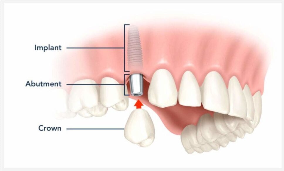 Compare The Average Cost Of Dental Implants Abroad Medical Tourism Dental Implants Make