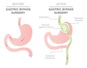 Weight Loss Surgery Abroad - Make Medical Trip | Medical Tourism | Find ...