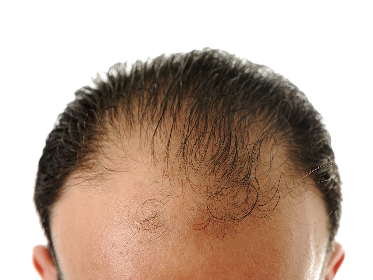How Much Does A Hair Transplant Abroad Actually Cost? - Make Medical Trip |  Medical Tourism | Find Medical Treatment Abroad